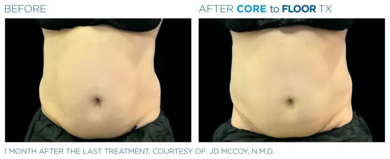 EmSculpt NEO Before and After | Aesthetic Lab