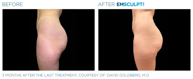 EmSculpt NEO Before and After | Aesthetic Lab