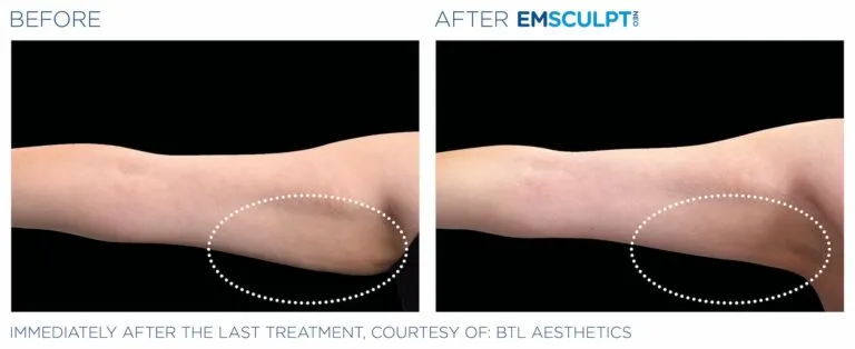 EmSculpt NEO Before and After by Aesthetic Lab