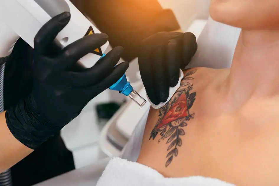 Laser Tattoo Removal Services in Modesto, CA by Aesthetic Lab