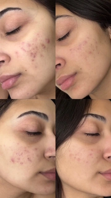 Microneedling Before and after Results in Modesto, Turlock, Stockton, CA at Aesthetic Lab