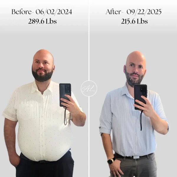 Weight Loss Before and after Results in Modesto, Turlock, Stockton, CA at Aesthetic Lab