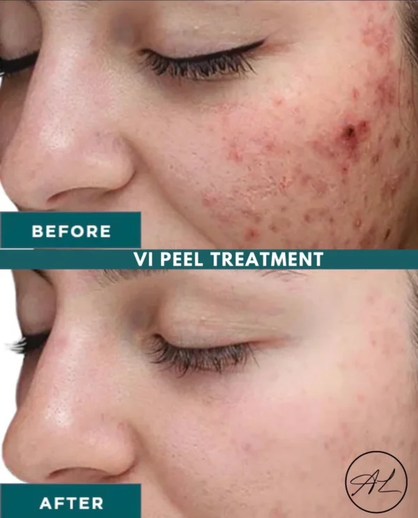 VI Peel Before and after Results in Modesto, Turlock, Stockton, CA at Aesthetic Lab