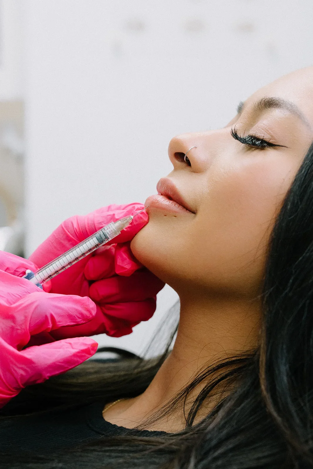 Client receiving Fillers in Modesto, Turlock, Stockton, CA at Aesthetic Lab